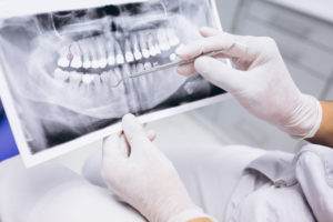 implantes dentales precio